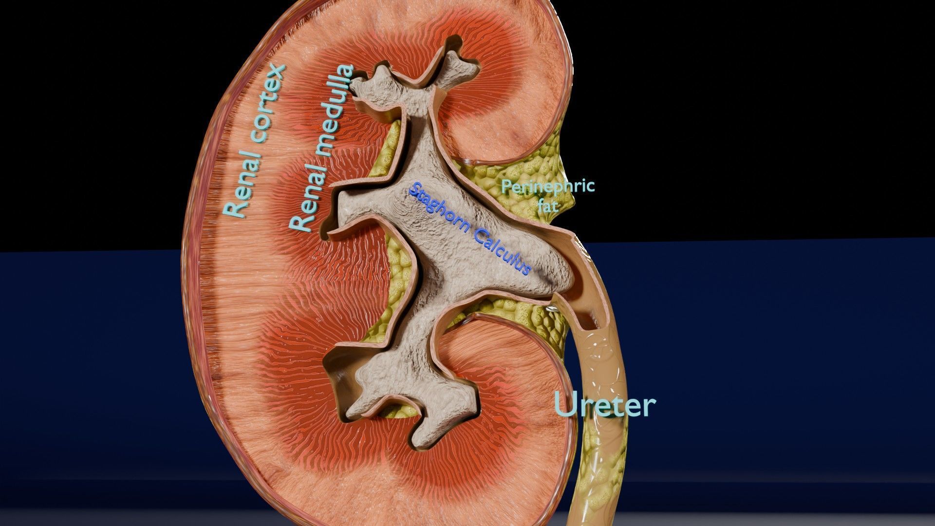 Kidney stone nephrolithiasis Staghorn calculus Low-poly 3D model_1