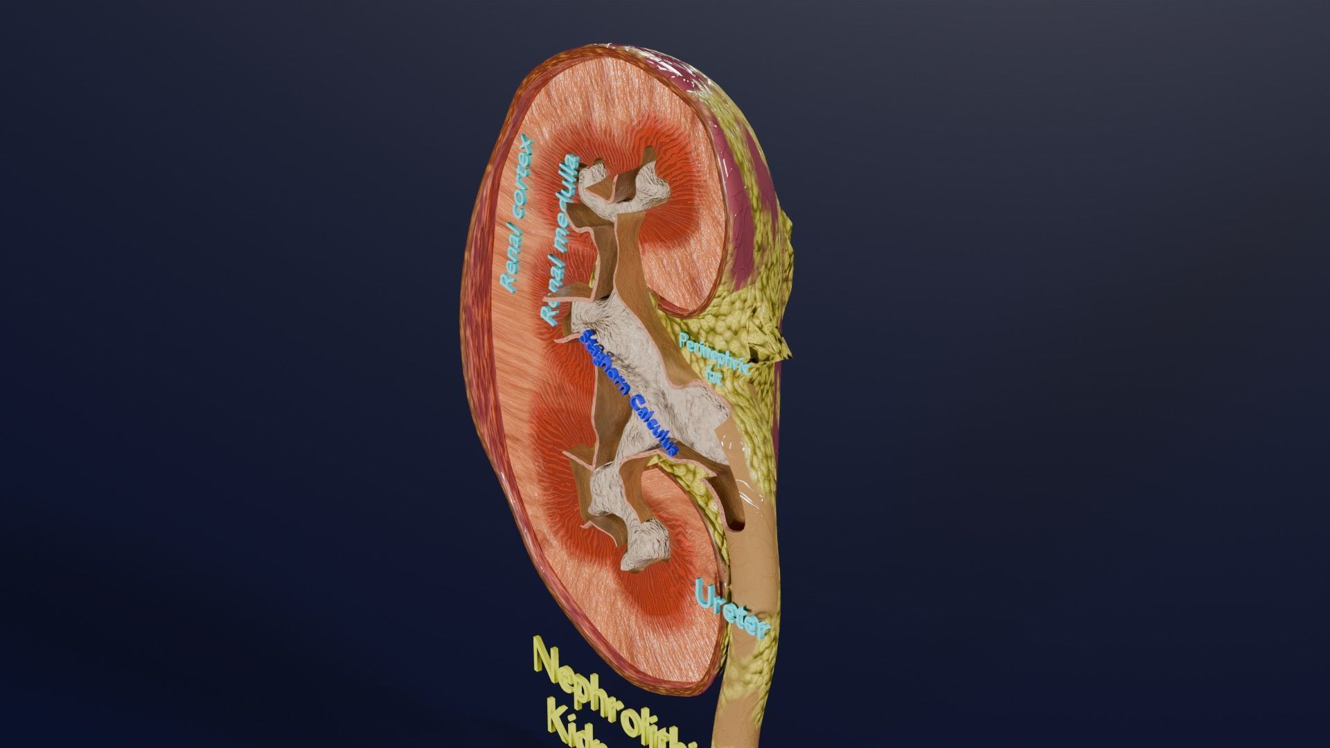Kidney stone nephrolithiasis Staghorn calculus Low-poly 3D model_11