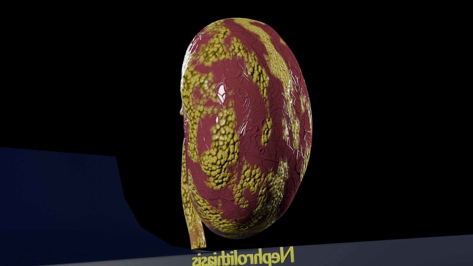 Kidney stone nephrolithiasis Staghorn calculus Low-poly 3D model_19