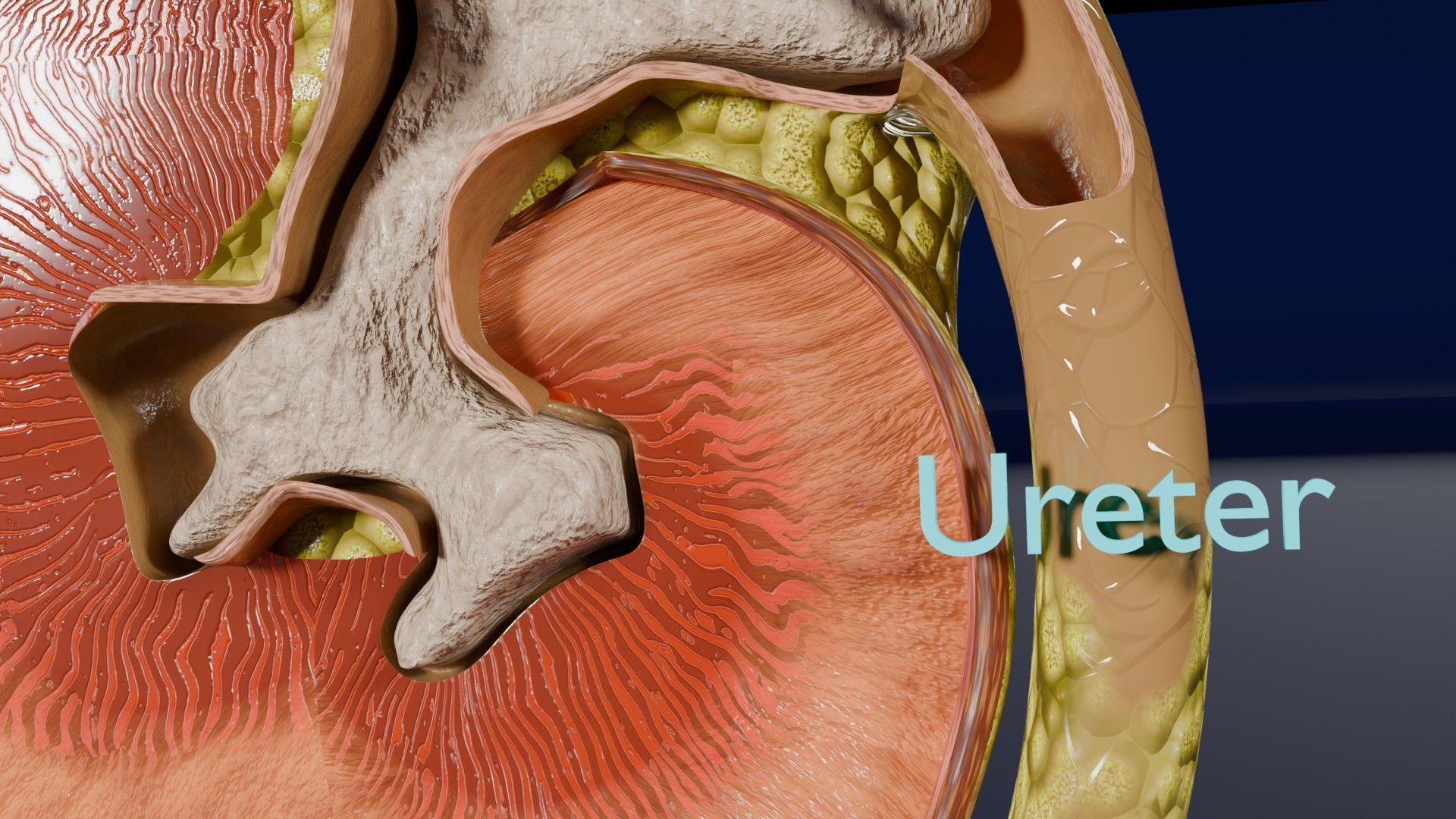 Kidney stone nephrolithiasis Staghorn calculus Low-poly 3D model_5
