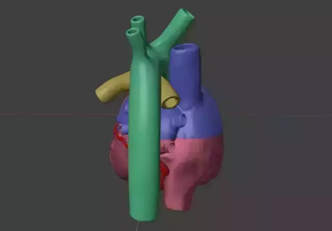 3D Model of Heart with Atrial Septal Defect 