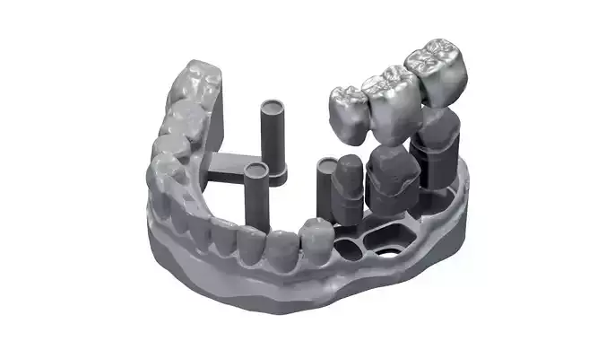 Mandibular Dental Anatomy with Pins and Bridge Real Medical Case