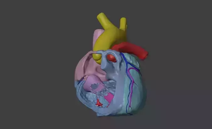 3D Model of Heart with Tetralogy of Fallot