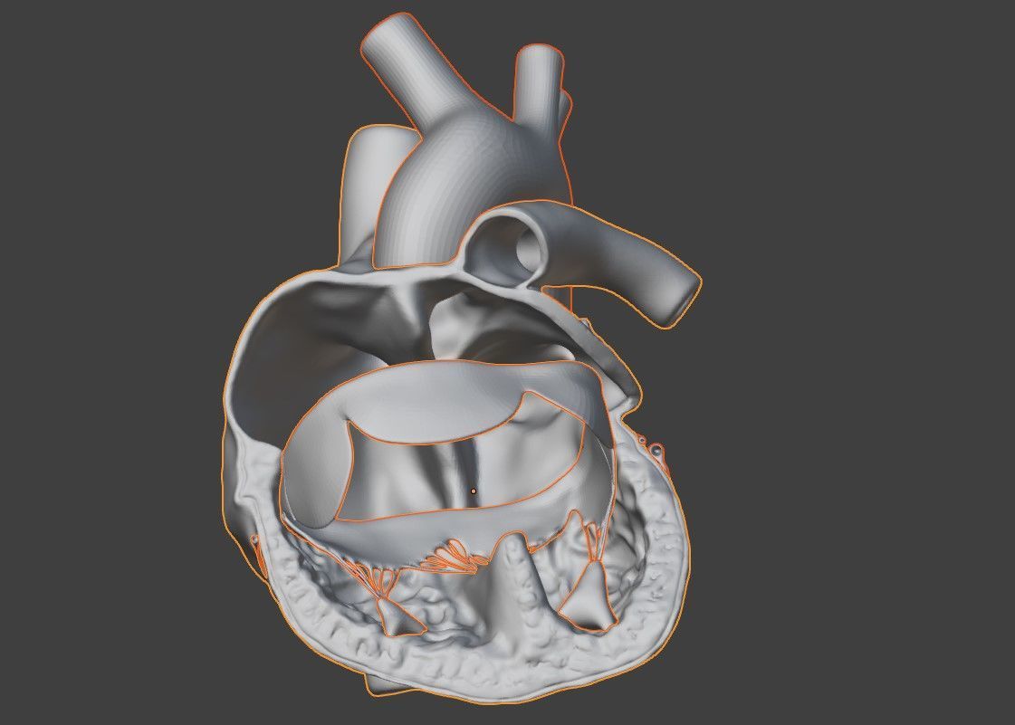 3D Model of Heart with Atrioventricular Canal Defect 3D model_9