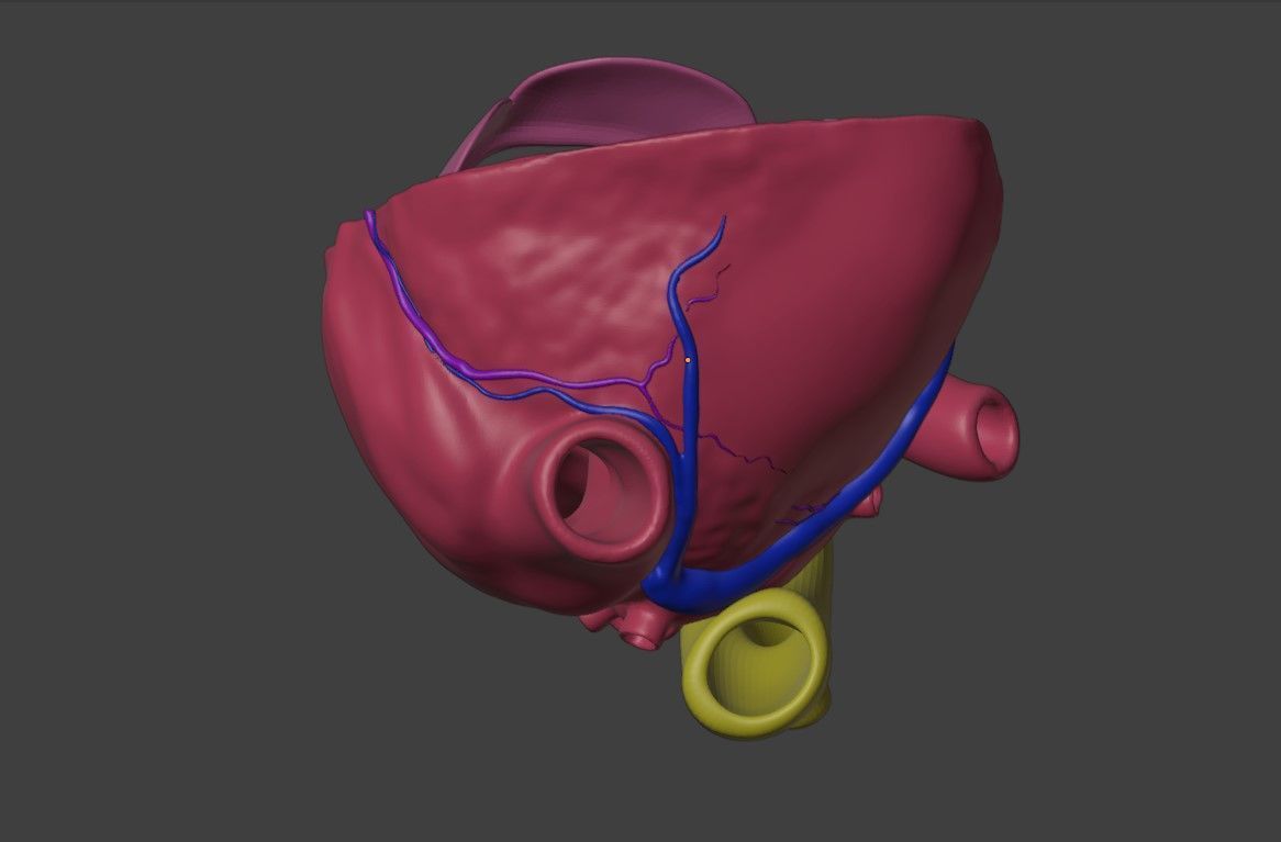 3D Model of Heart with Atrioventricular Canal Defect 3D model_5