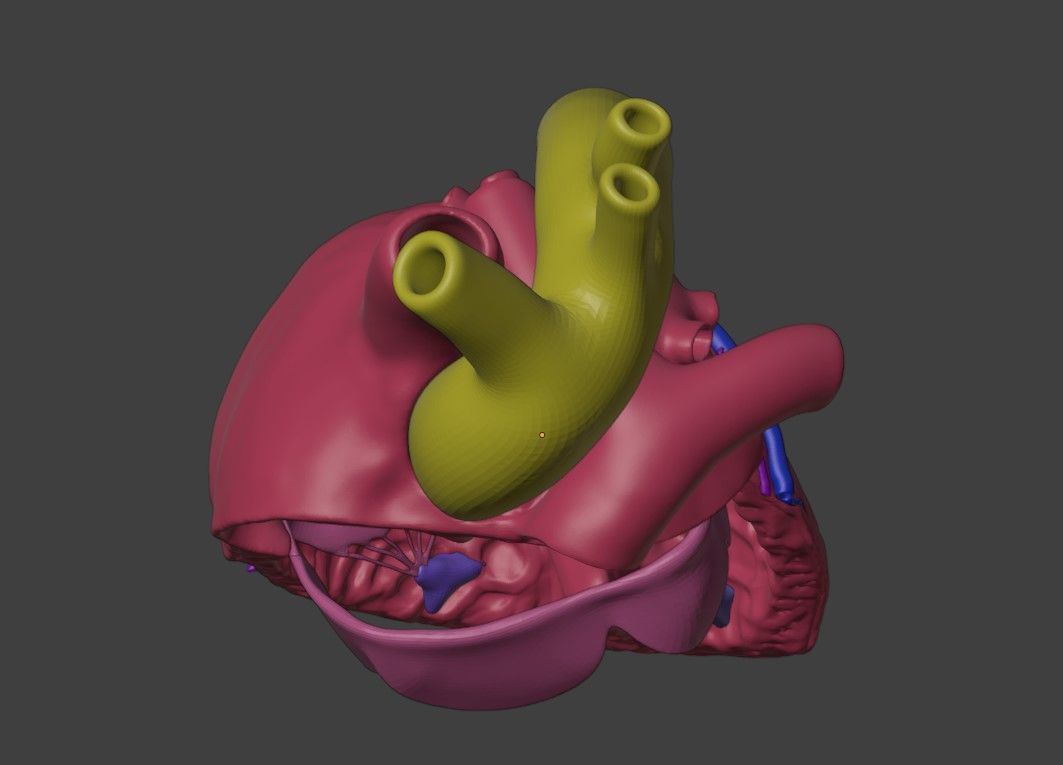 3D Model of Heart with Atrioventricular Canal Defect 3D model_4