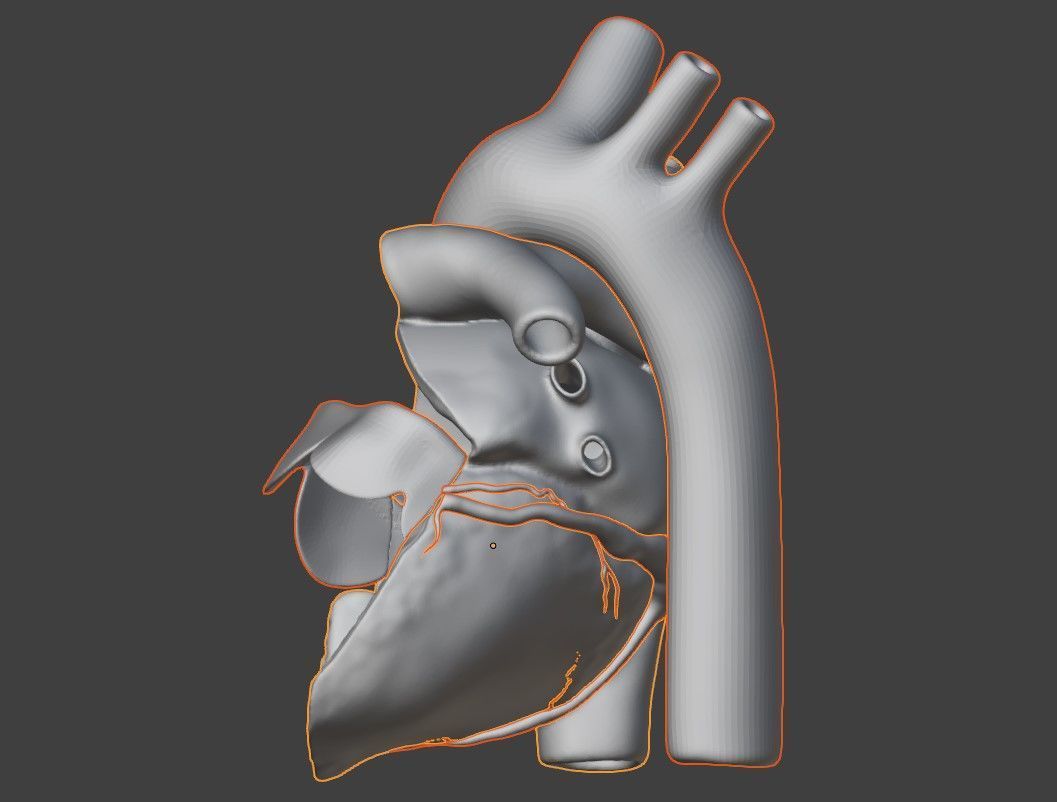 3D Model of Heart with Atrioventricular Canal Defect 3D model_8