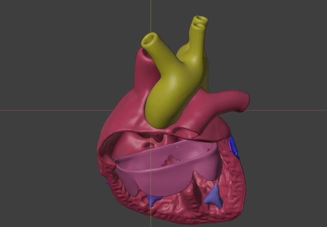 3D Model of Heart with Atrioventricular Canal Defect 3D model_6