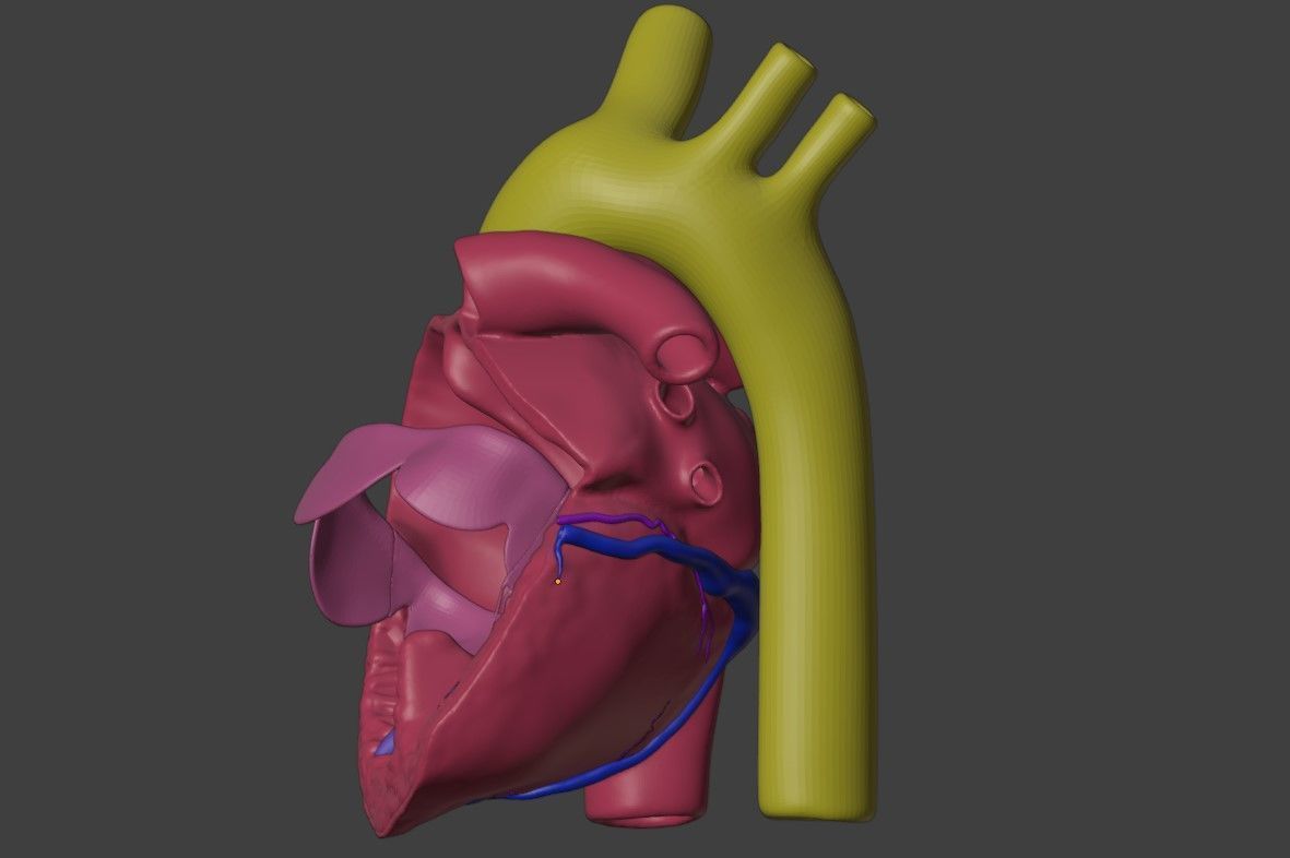 3D Model of Heart with Atrioventricular Canal Defect 3D model_7