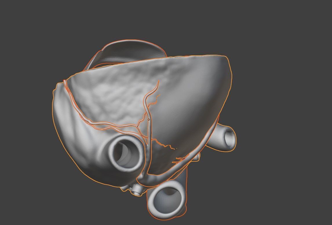 3D Model of Heart with Atrioventricular Canal Defect 3D model_12