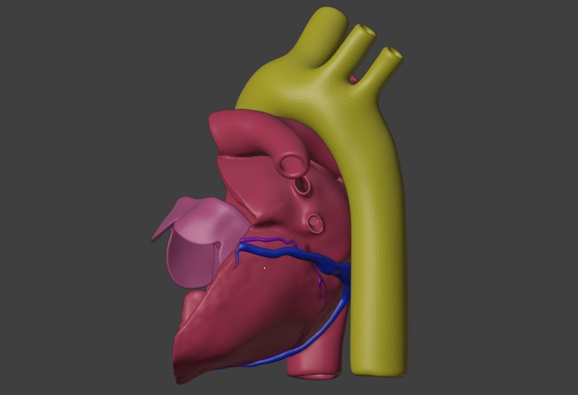 3D Model of Heart with Atrioventricular Canal Defect 3D model_1