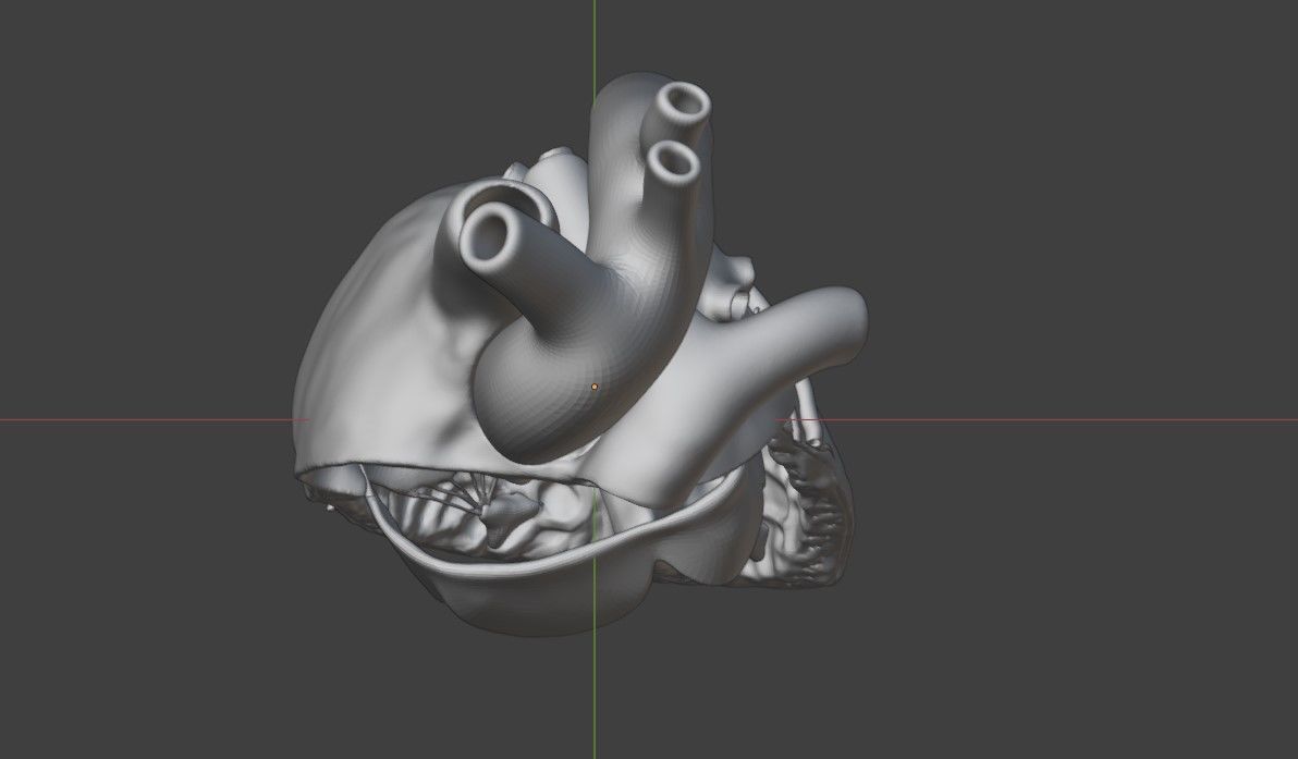 3D Model of Heart with Atrioventricular Canal Defect 3D model_11