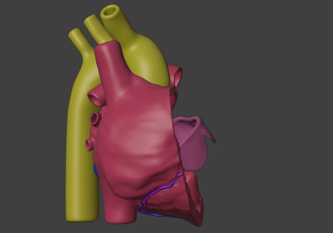 3D Model of Heart with Atrioventricular Canal Defect 3D model_2