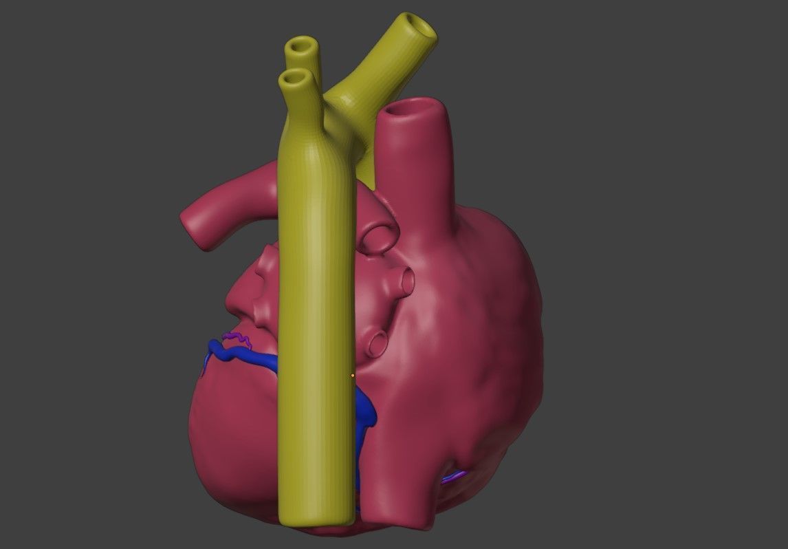 3D Model of Heart with Atrioventricular Canal Defect 3D model_3