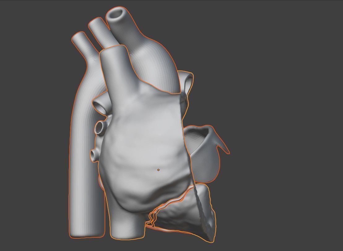 3D Model of Heart with Atrioventricular Canal Defect 3D model_10