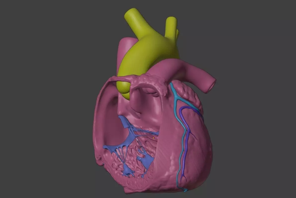 3D Model of Heart with Double Outlet Right Ventricle 3D print model