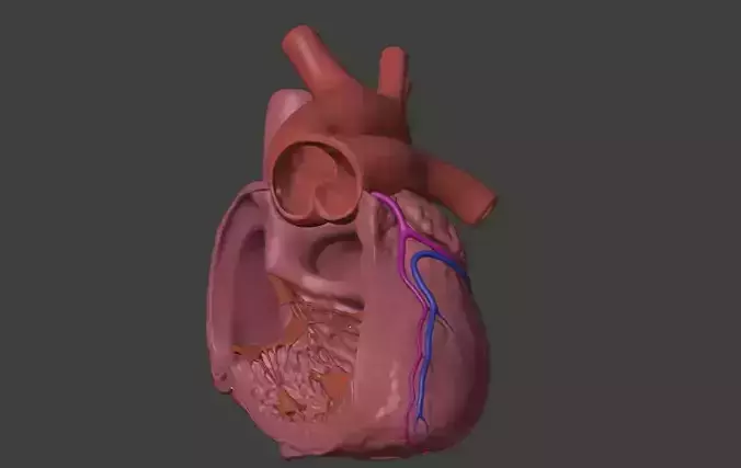 3D Model of Heart with Truncus Arteriosus