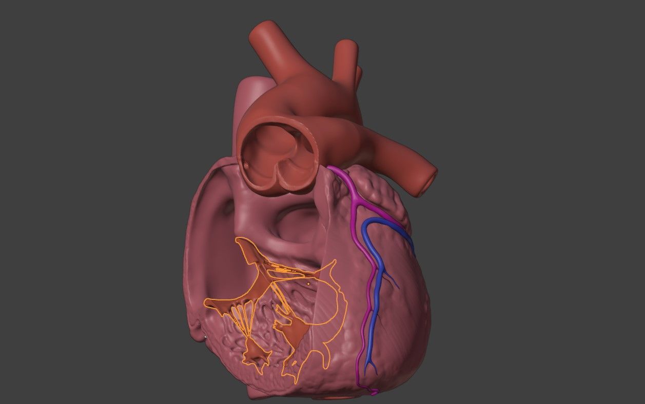 3D Model of Heart with Truncus Arteriosus 3D model_7