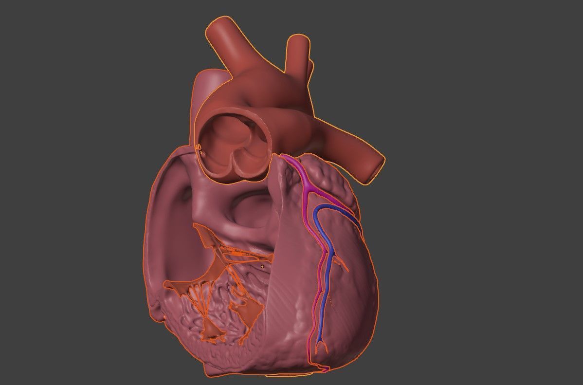 3D Model of Heart with Truncus Arteriosus 3D model_5