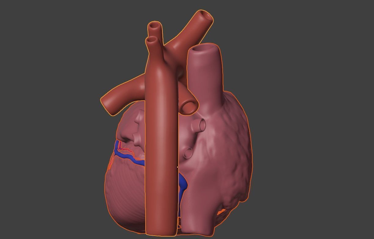 3D Model of Heart with Truncus Arteriosus 3D model_6