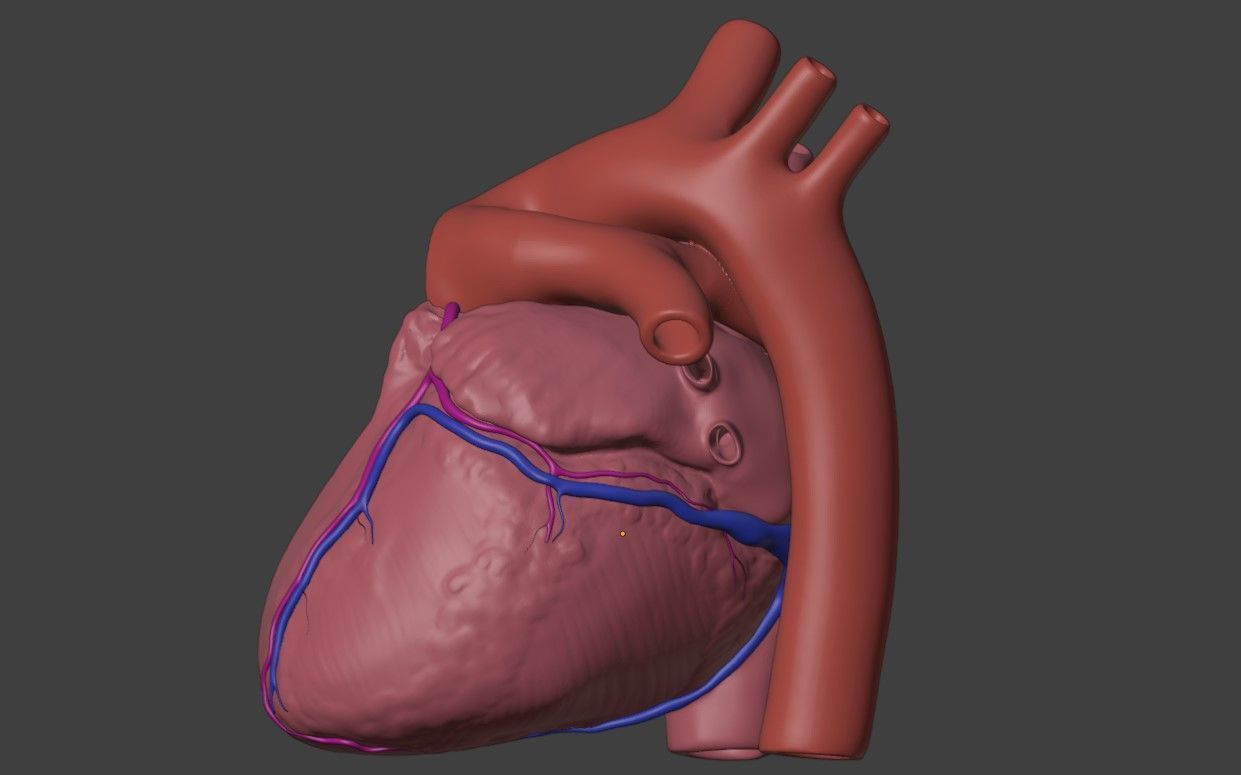 3D Model of Heart with Truncus Arteriosus 3D model_1
