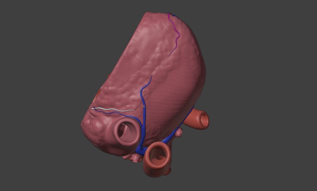 3D Model of Heart with Truncus Arteriosus 3D model_4