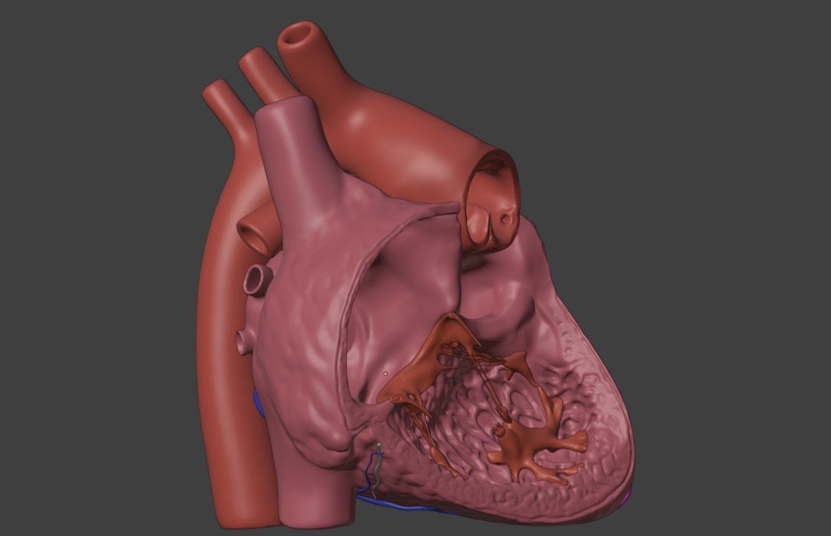 3D Model of Heart with Truncus Arteriosus 3D model_2