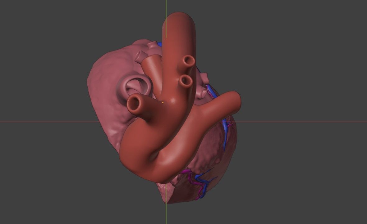 3D Model of Heart with Truncus Arteriosus 3D model_3