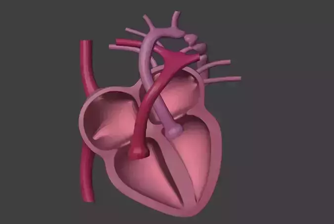 3D Model of Heart with Coarctation of Aorta