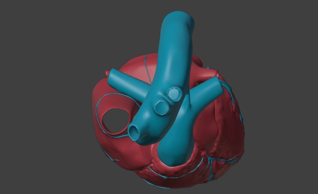 3D Model of Heart with Atrioventricular Septal Defect  3D model_3