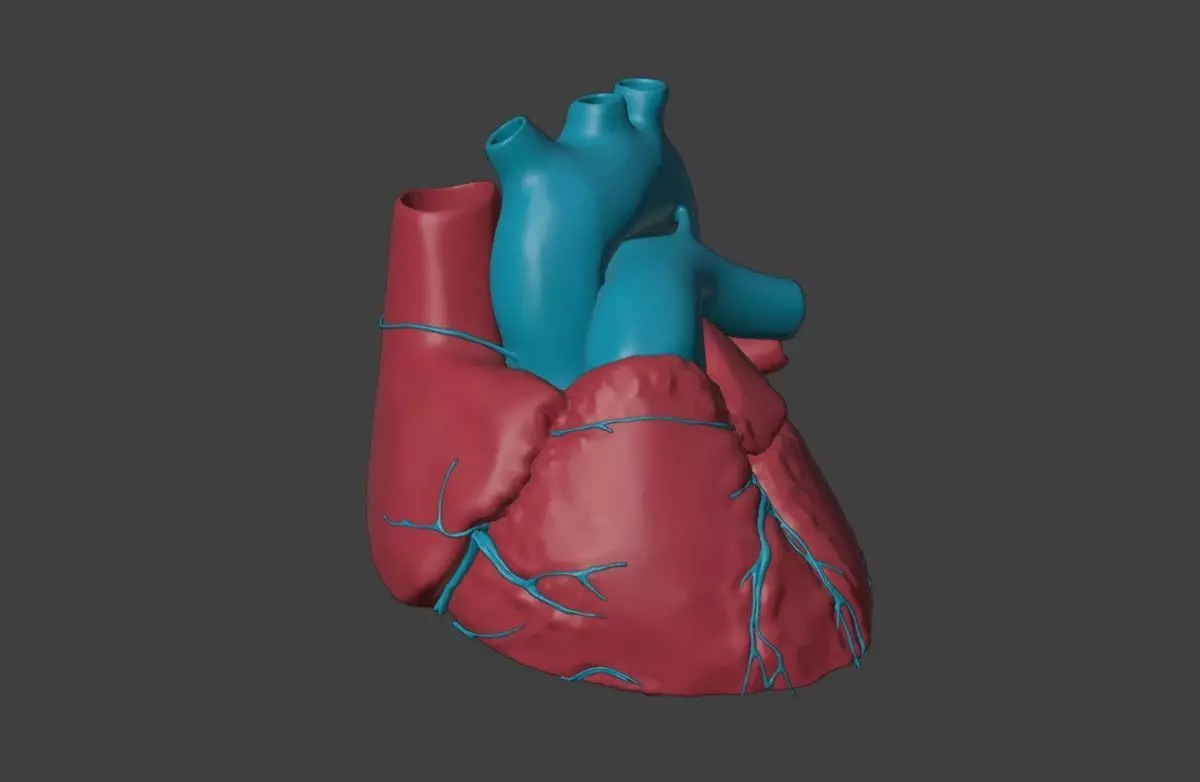 3D Model of Heart with Atrioventricular Septal Defect  3D model_0