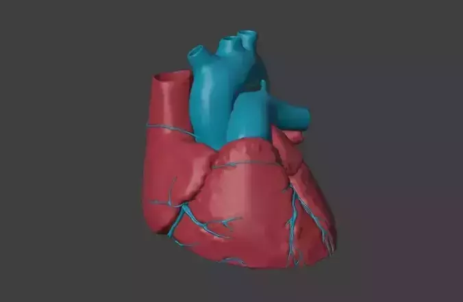 3D Model of Heart with Atrioventricular Septal Defect  3D model