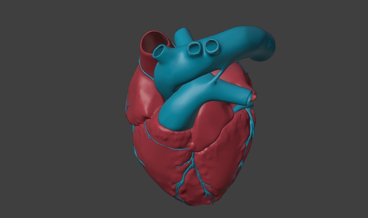 3D Model of Heart with Atrioventricular Septal Defect  3D model_1