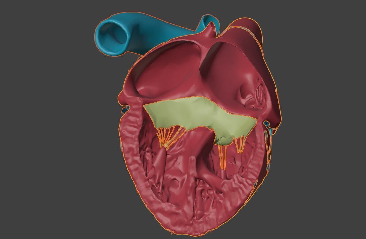 3D Model of Heart with Atrioventricular Septal Defect  3D model_5
