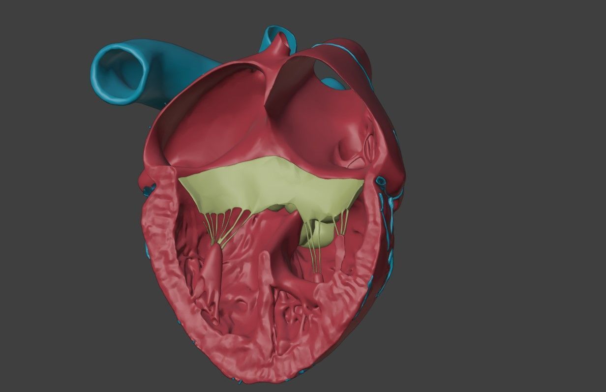 3D Model of Heart with Atrioventricular Septal Defect  3D model_2