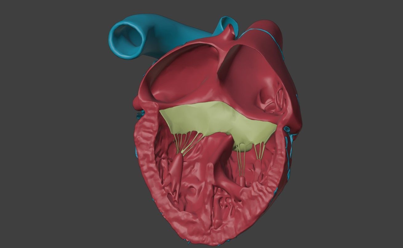 3D Model of Heart with Atrioventricular Septal Defect  3D model_4