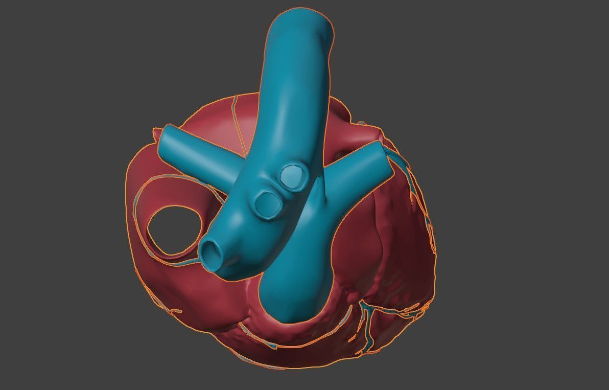 3D Model of Heart with Atrioventricular Septal Defect  3D model_6