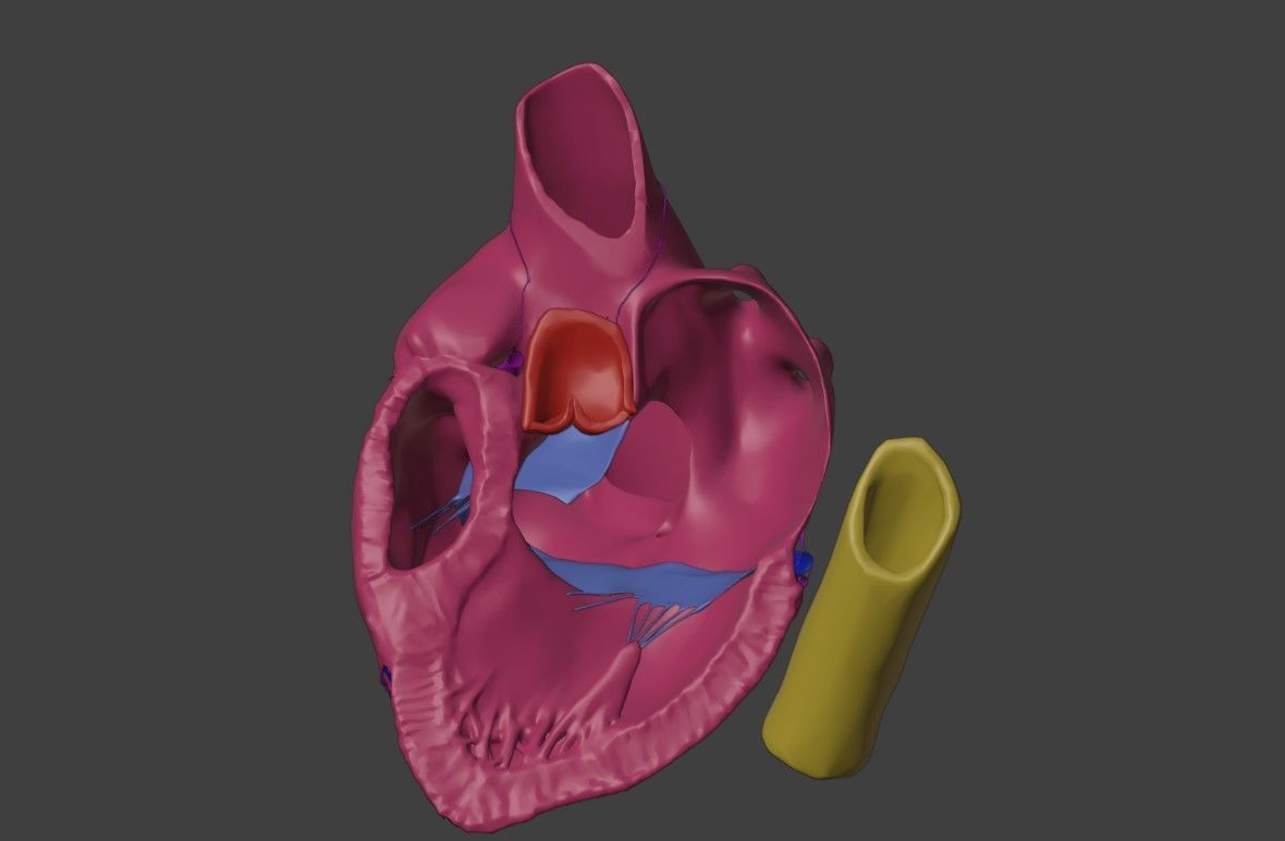 3D Model of Heart with Atrioventricular Septal Defect - PSLAX 3D model_7