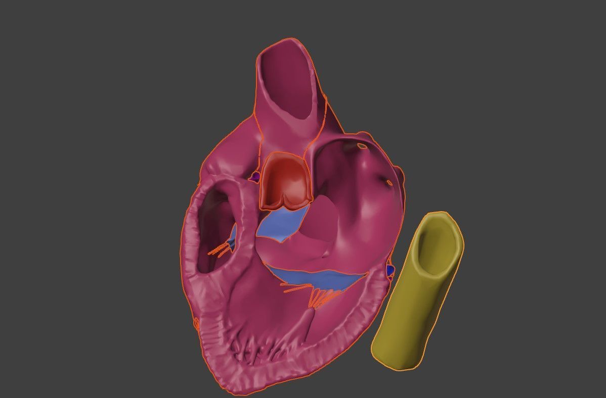 3D Model of Heart with Atrioventricular Septal Defect - PSLAX 3D model_8