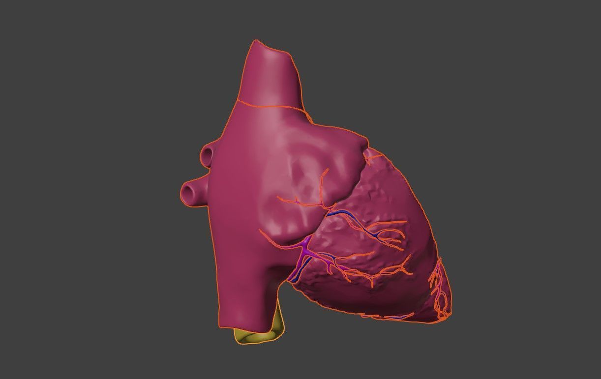 3D Model of Heart with Atrioventricular Septal Defect - PSLAX 3D model_1