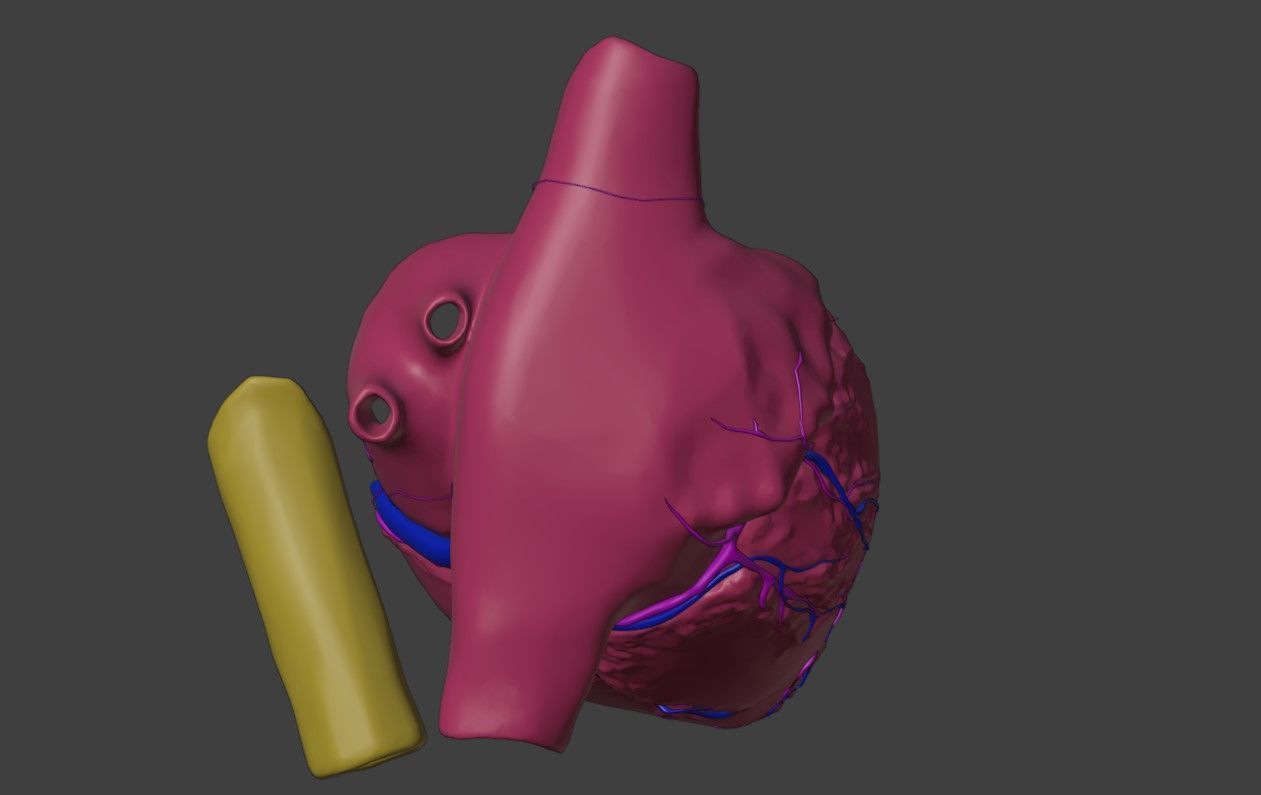 3D Model of Heart with Atrioventricular Septal Defect - PSLAX 3D model_3