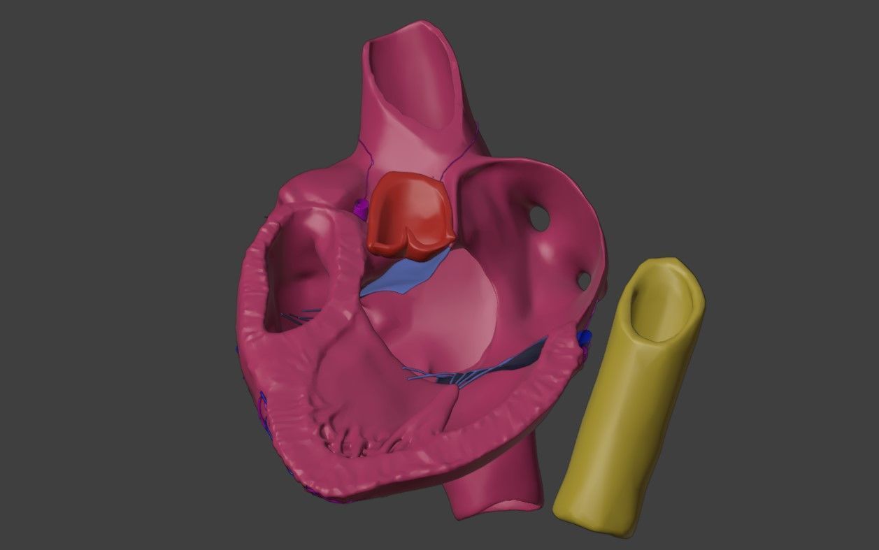 3D Model of Heart with Atrioventricular Septal Defect - PSLAX 3D model_2