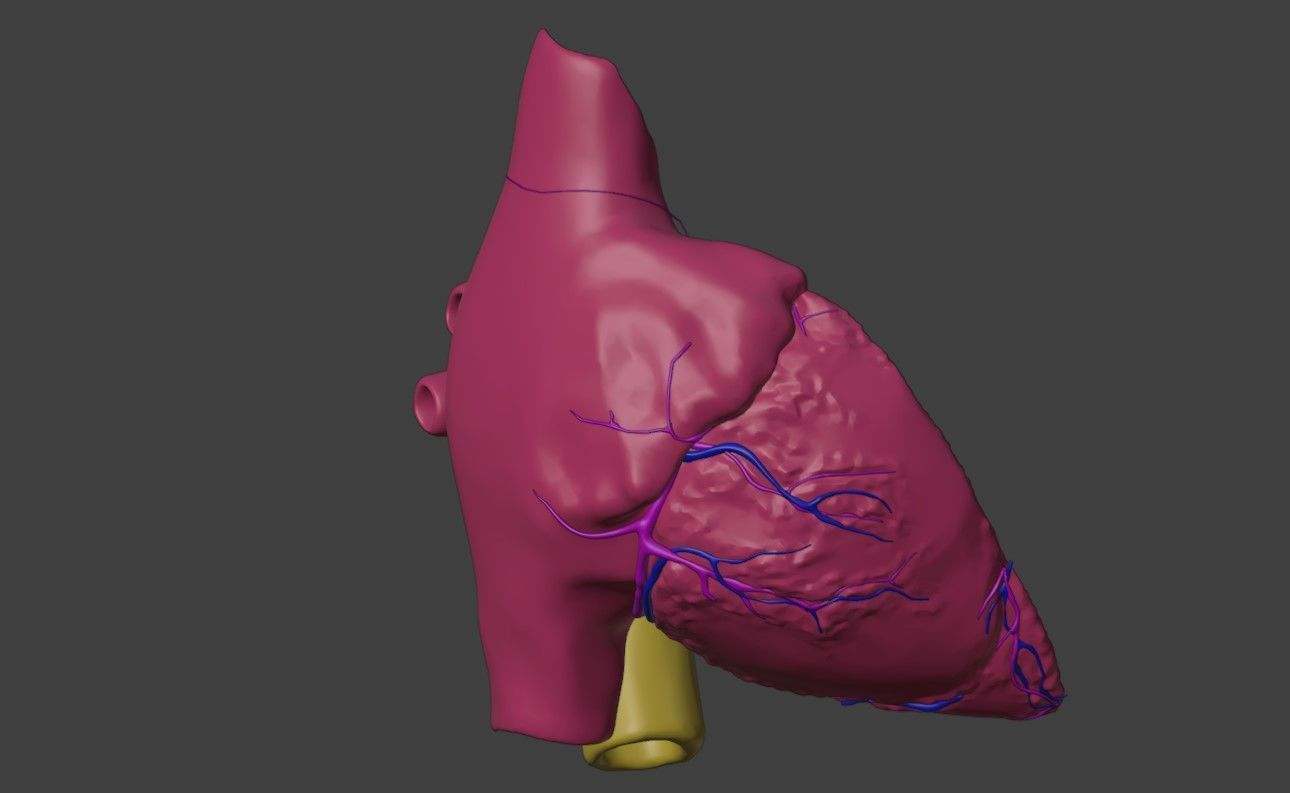 3D Model of Heart with Atrioventricular Septal Defect - PSLAX 3D model_6