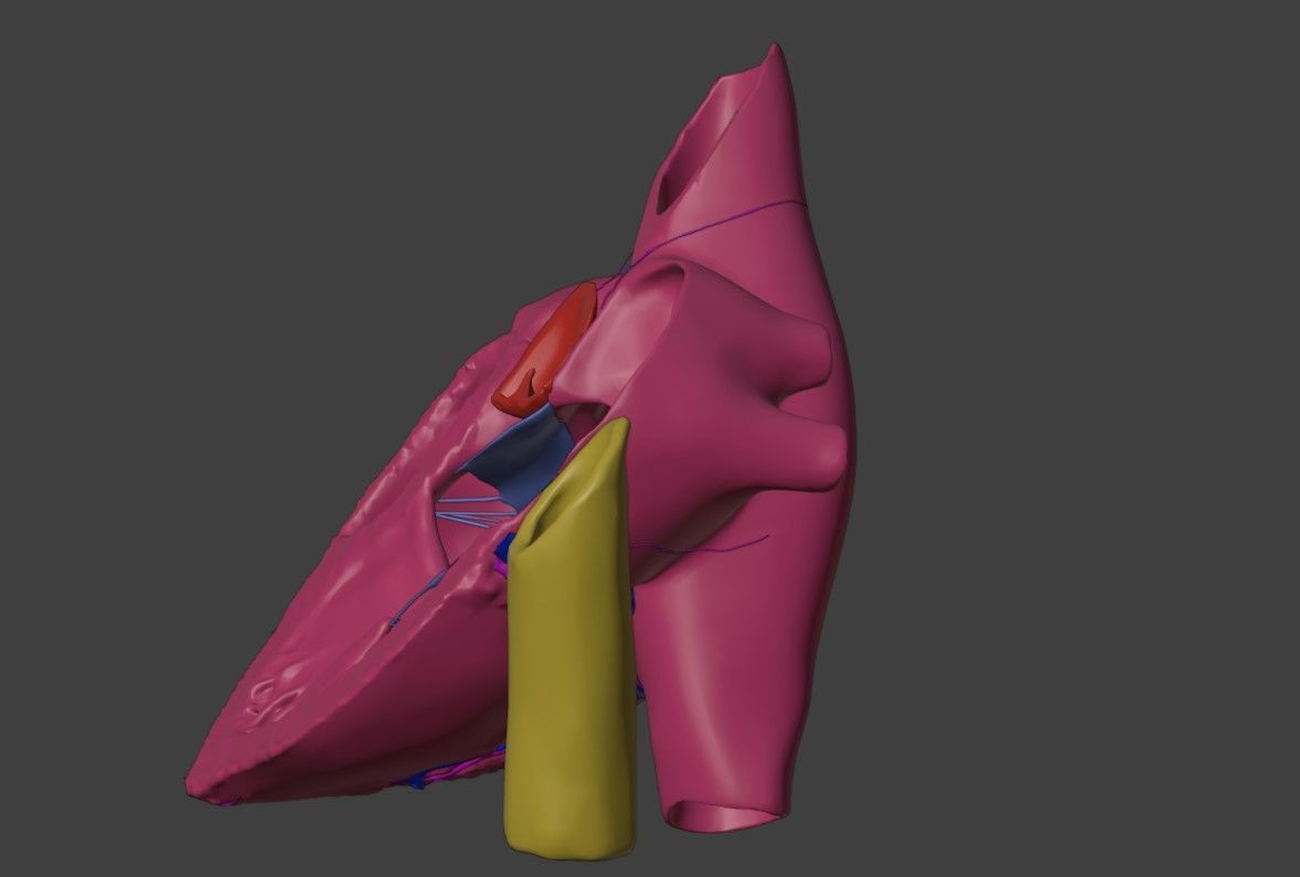 3D Model of Heart with Atrioventricular Septal Defect - PSLAX 3D model_4