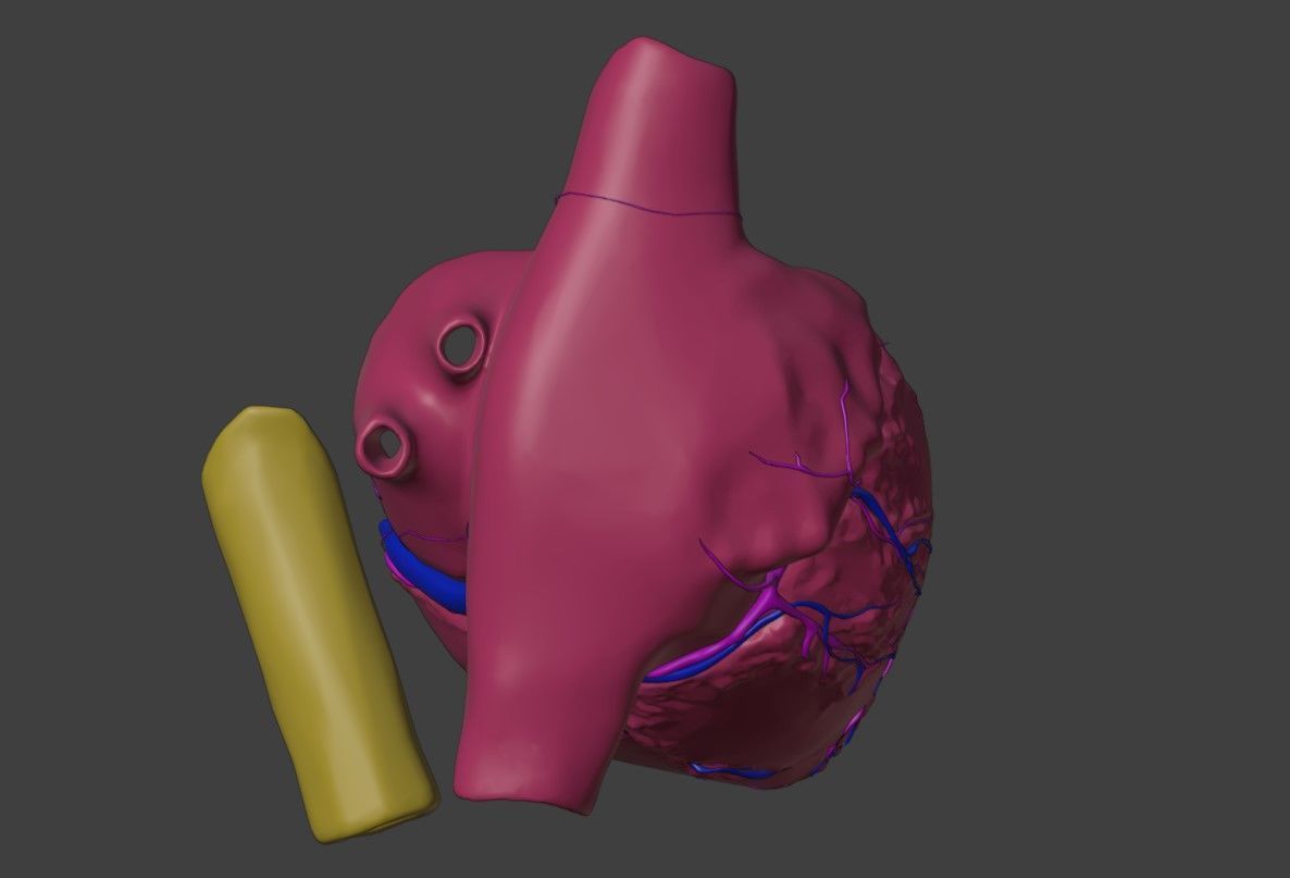 3D Model of Heart with Atrioventricular Septal Defect - PSLAX 3D model_5