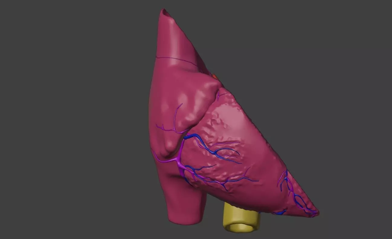 3D Model of Heart with Atrioventricular Septal Defect - PSLAX 3D model_0