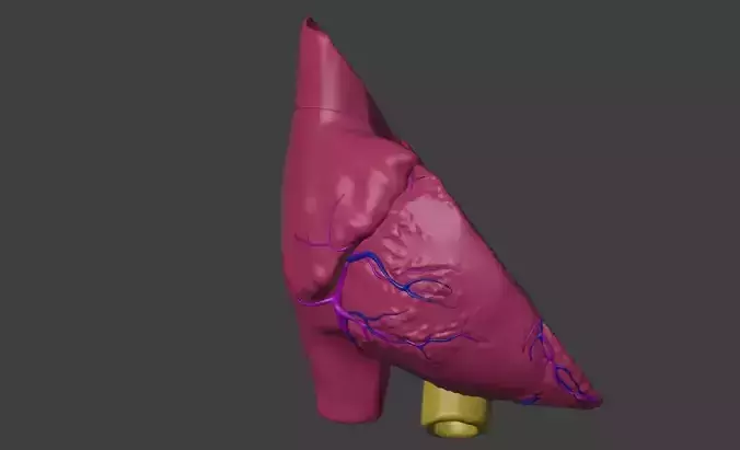 3D Model of Heart with Atrioventricular Septal Defect - PSLAX 3D model