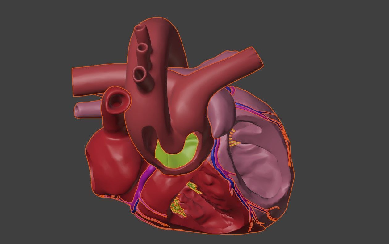 3D Model of Heart with Common Arterial Trunk Truncus Arteriosus 3D model_6