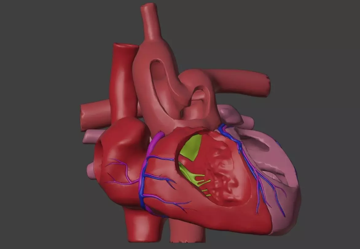 3D Model of Heart with Common Arterial Trunk Truncus Arteriosus 3D model_0