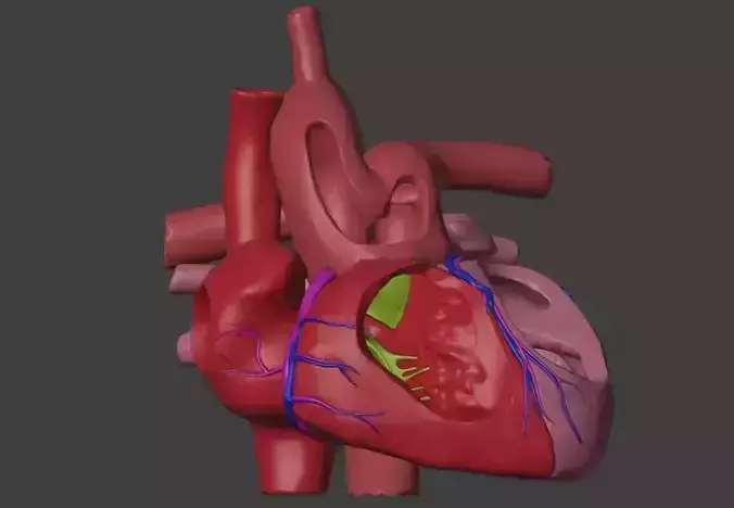 3D Model of Heart with Common Arterial Trunk Truncus Arteriosus